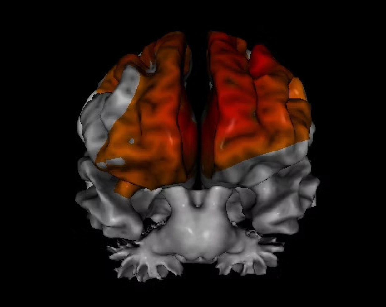 EEG image of patient with ADHD