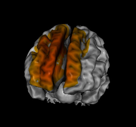 Sleep disorder showing in brain from loreta neurofeedback