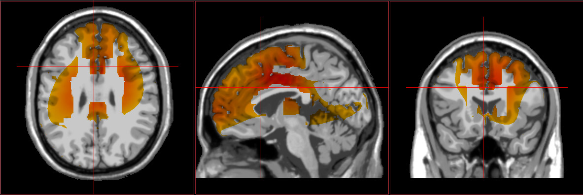 image of swLoretta brain scans showing ADHD symptoms
