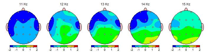 QEEG graphic showing signs of addiction
