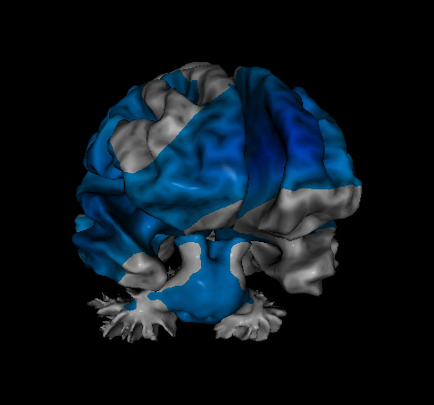 loreta neurofeedback showing addition issues
