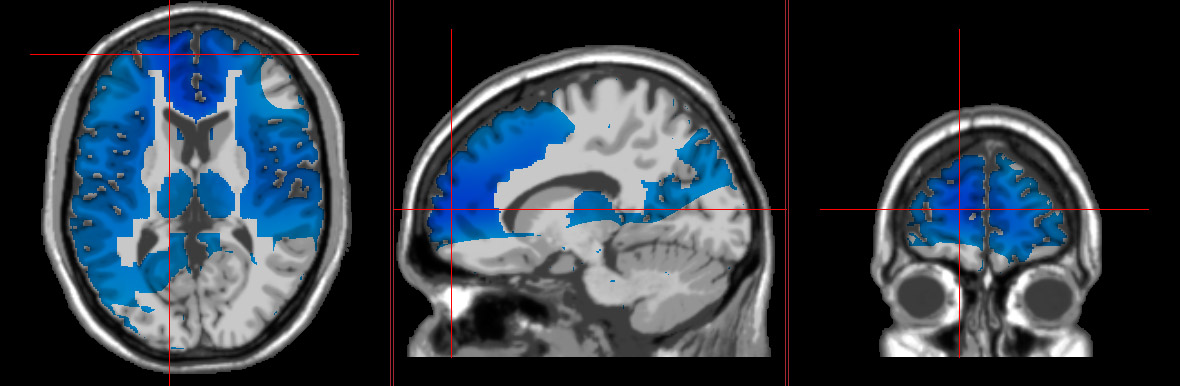 loreta neurofeedback with the brain showing sign sof addiction