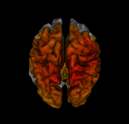 loreta neurofeedback showing typical signs of chronic stress