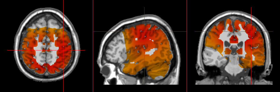 chronic stress shown in the brain by loreta neurofeedback