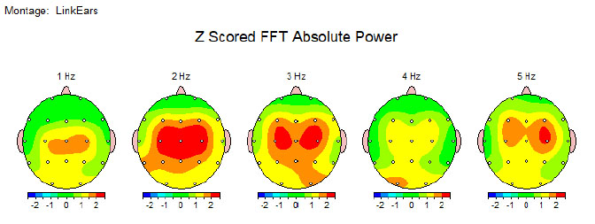 EEG scan of brain showing cognitive decline