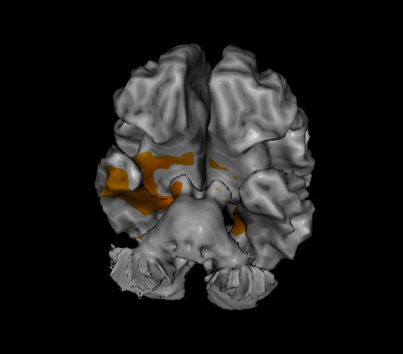 areas of the brain that show typical cognitive decline from loreta neurofeedback