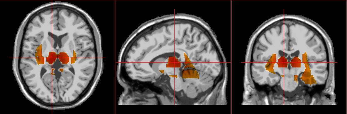 neurofeedback imaging that shows typical congnitive decline