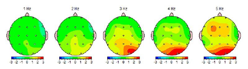 EEG graphics showing concussion