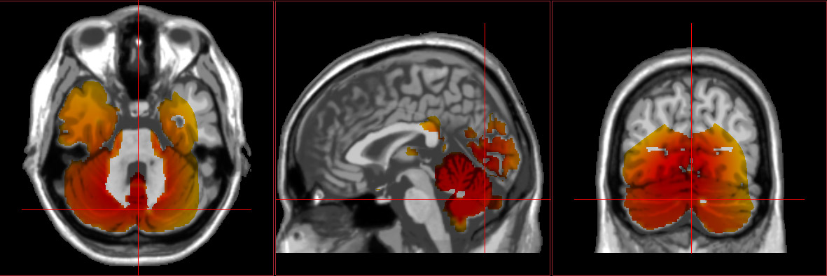 swLORETA brain scan showing a concussion