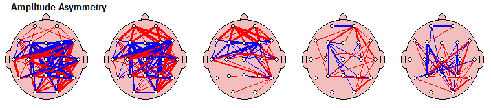 EEG scan showing signs of depression