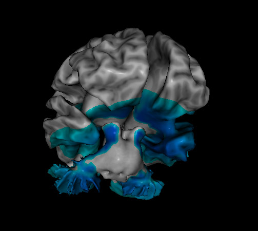 loreta neurofeedback showing the brain with depression