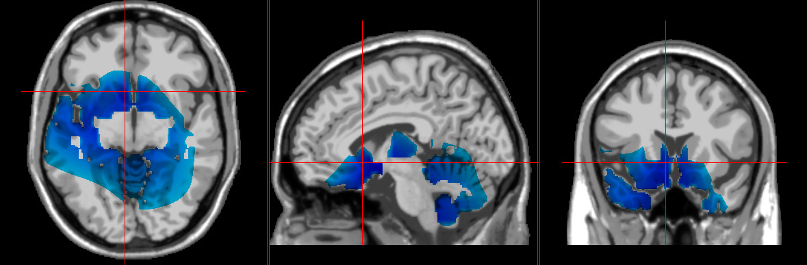 what having depression looks like in your brain with loreta neurofeedback
