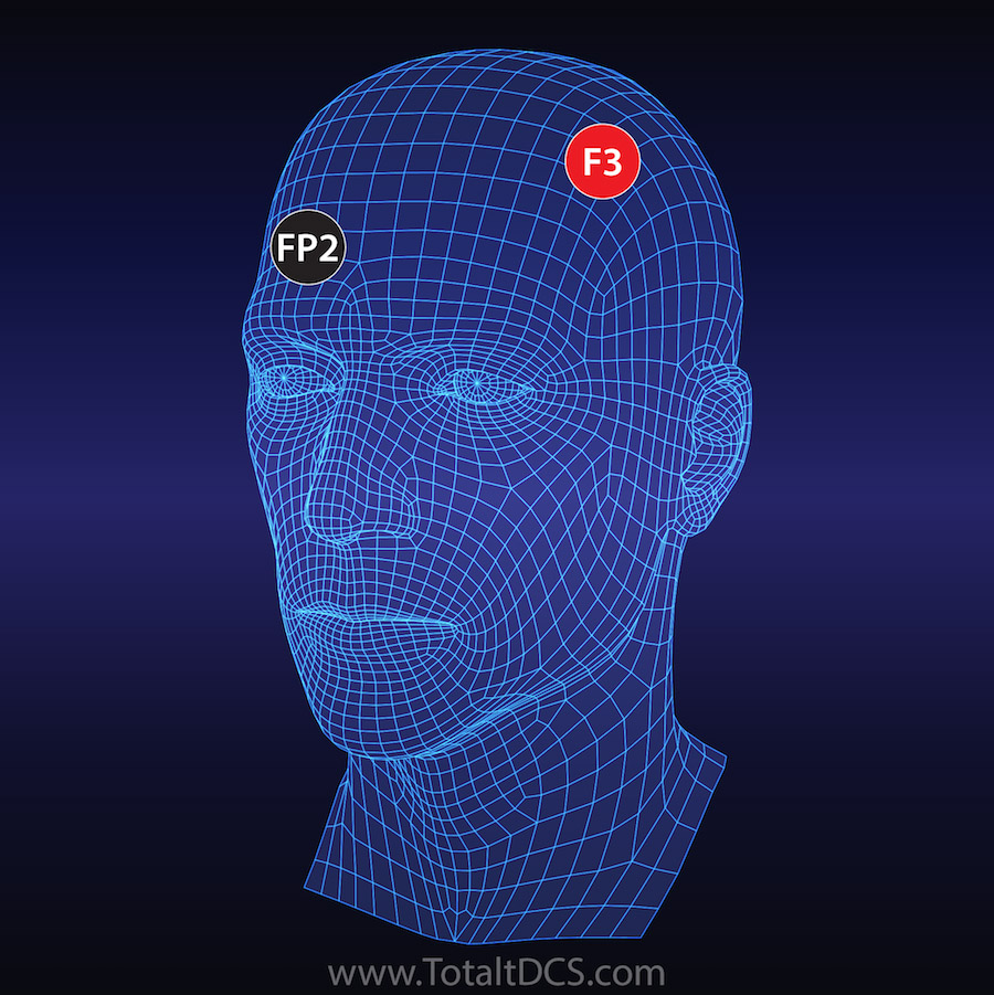 points on the brain with neurostimulation